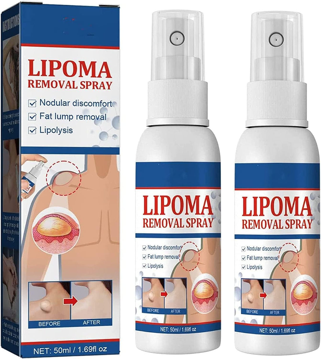 South Moon - Lipoma Removal Spray (Original)